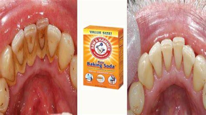 Does baking soda remove plaque?