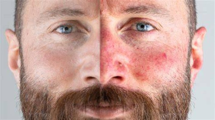 Does bbl help rosacea?