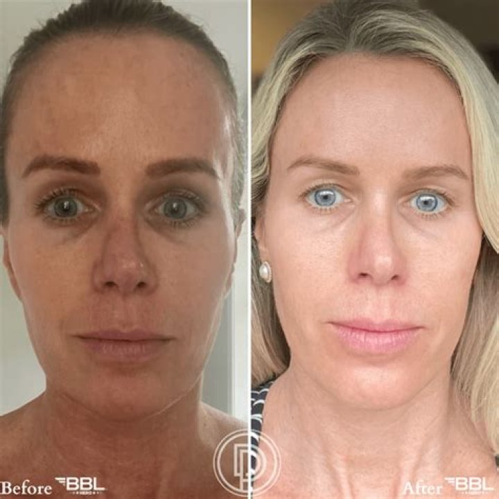 Does BBL reduce pore size?