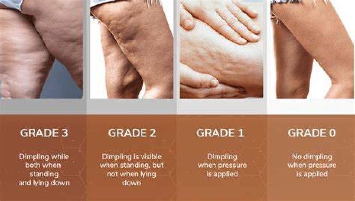 Does cellulite go away?