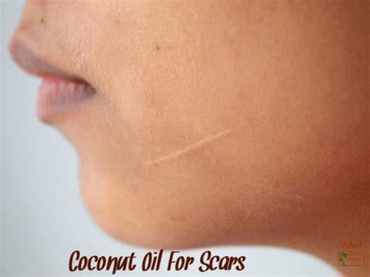 Does coconut oil help with scars?