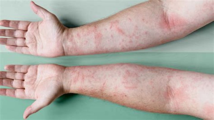 Does coffee trigger eczema?
