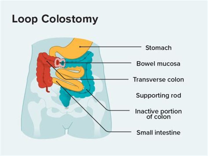 Does colectomy shorten life?