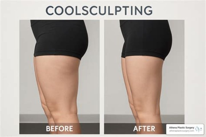 Does CoolSculpting get rid of cellulite on thighs?