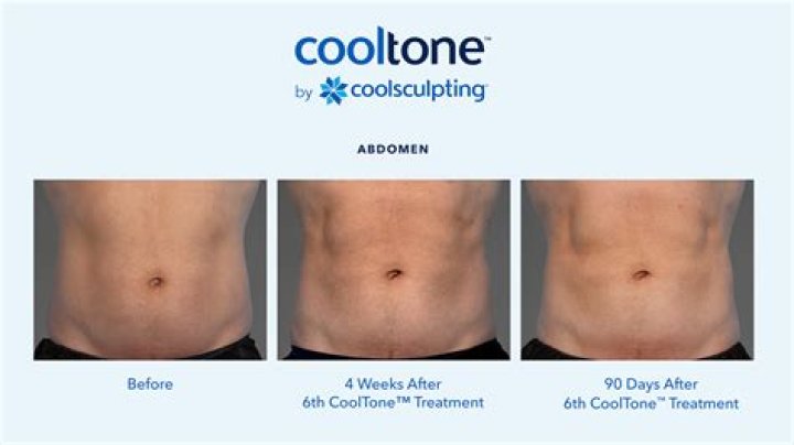 Does CoolSculpting work on thighs?