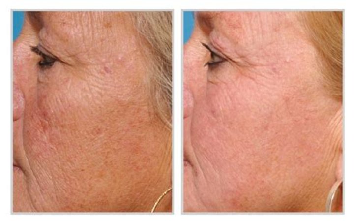 Does Halo laser tighten skin?