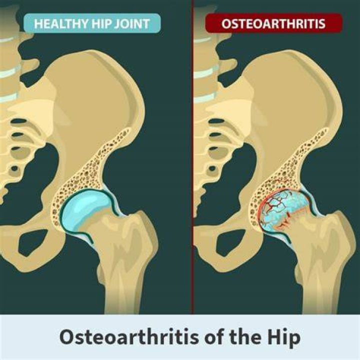 Does hip arthritis ever get better?