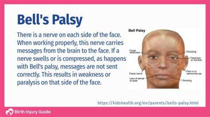 Does Karen Austin still have Bell's palsy?