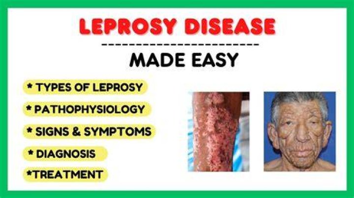 Does leprosy still exist today?