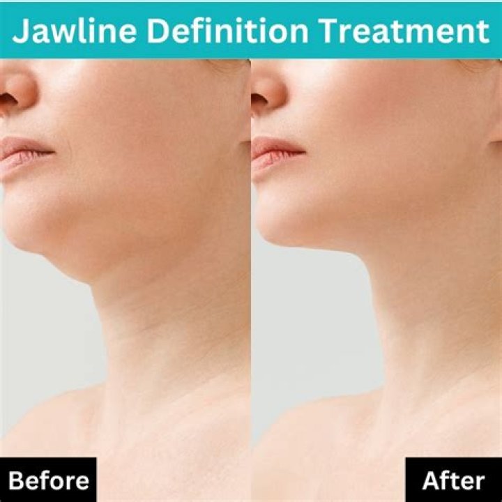 Does losing weight define your jawline?