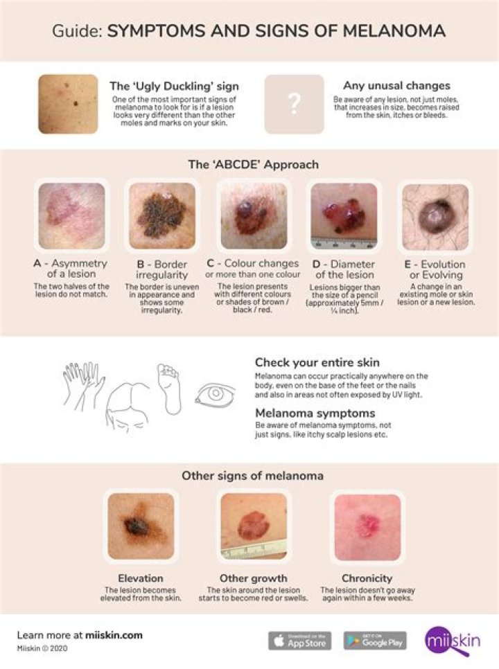Does melanoma appear suddenly?