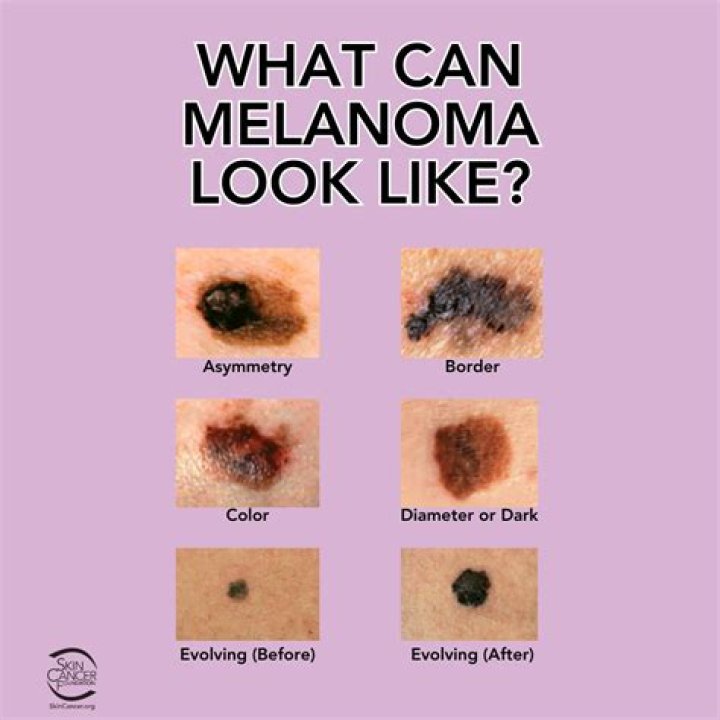Does melanoma look like a scab?