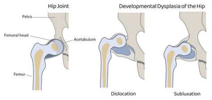Does mild hip dysplasia need surgery?