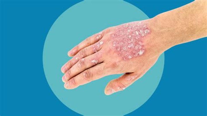 Does oatmeal help psoriasis?