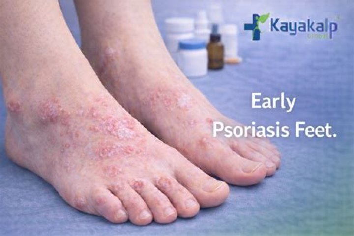 Does Parkinson's affect your feet?