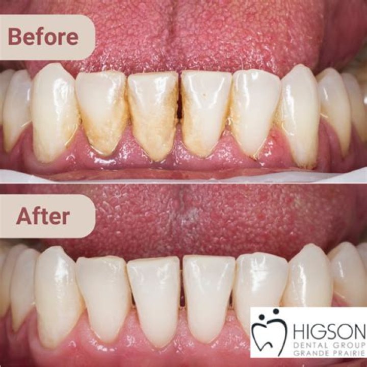 Does peroxide remove tartar from teeth?