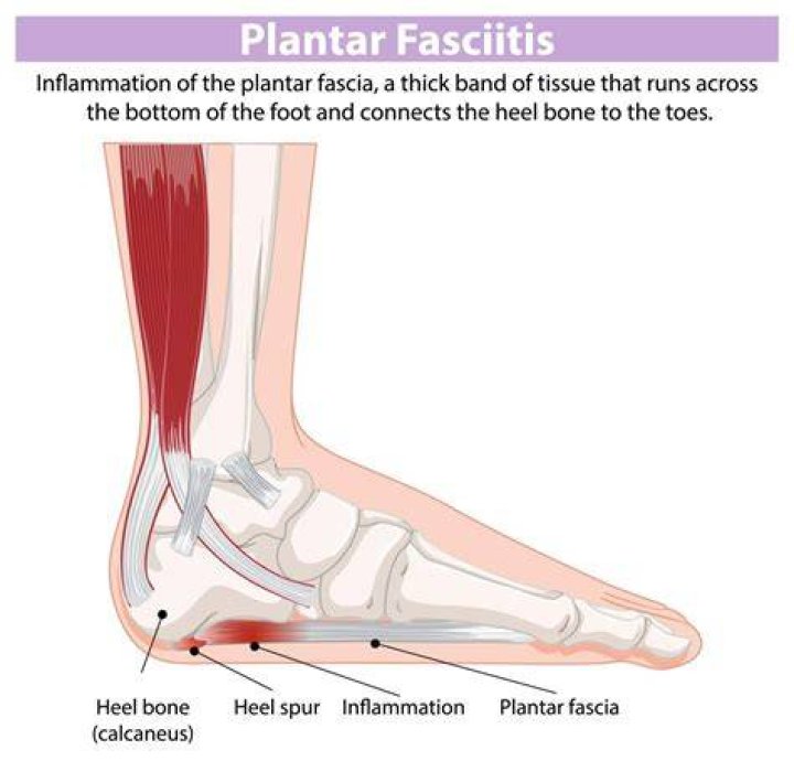 Does plantar fasciitis cause ankle pain?