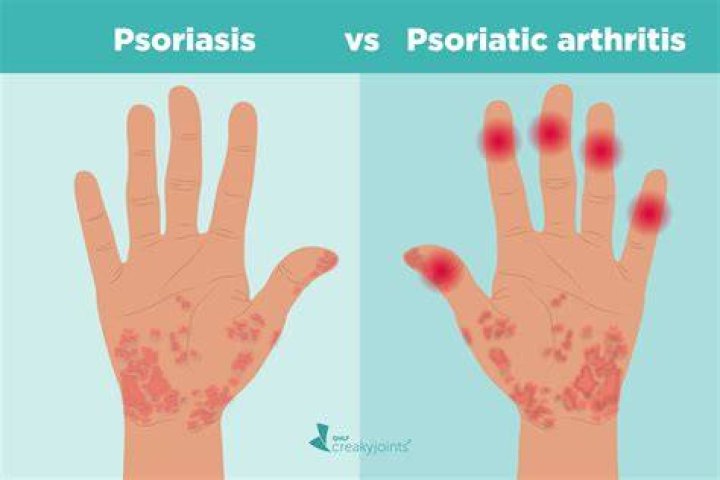 Does psoriatic arthritis show in bloodwork?