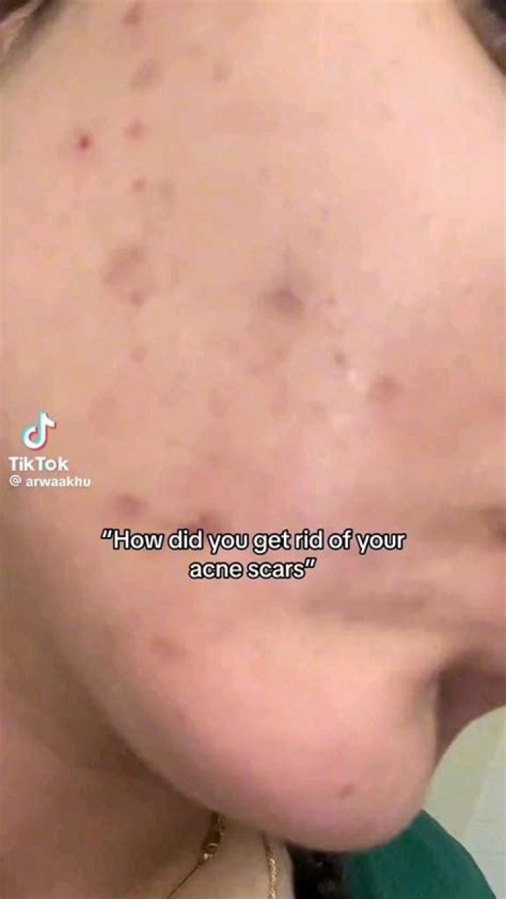 Does rice get rid of acne?