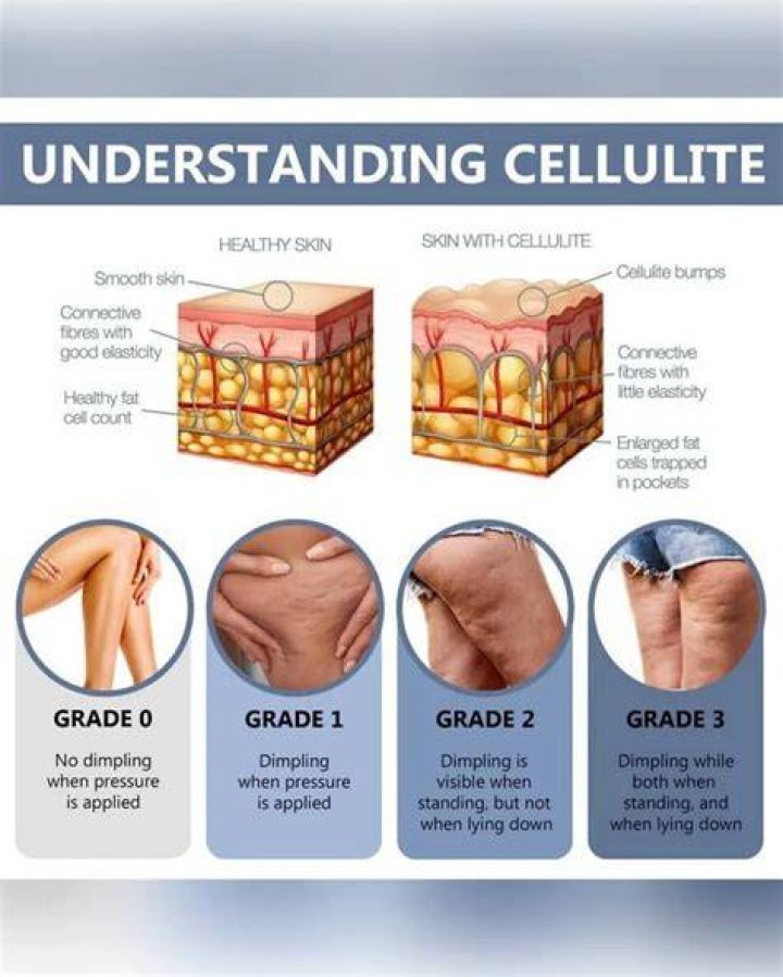 Does running get rid of cellulite?
