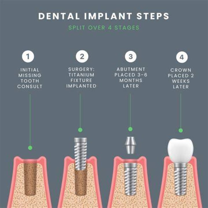 Does the Nexplanon implant last 4 years?