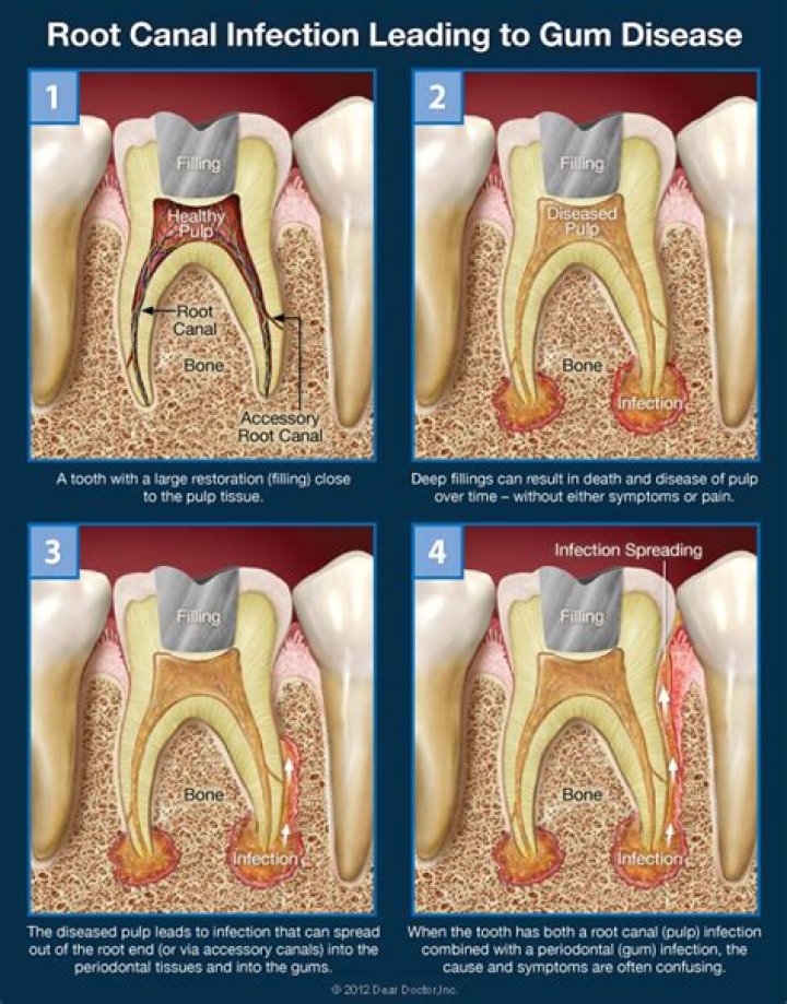 Does throbbing tooth pain mean root canal?