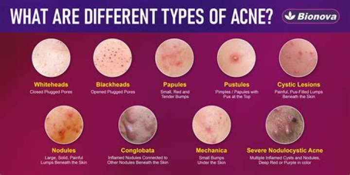 Does Vienva give you acne?