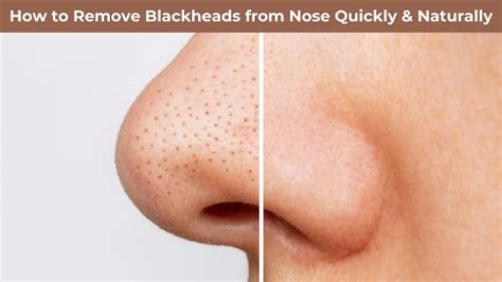 Does vitamin C remove blackheads?