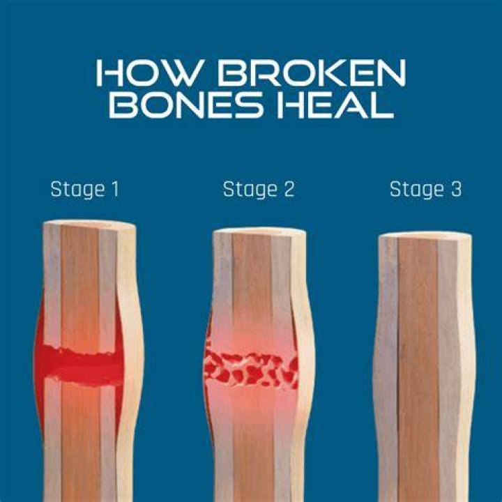 Does vitamin D help heal bones?