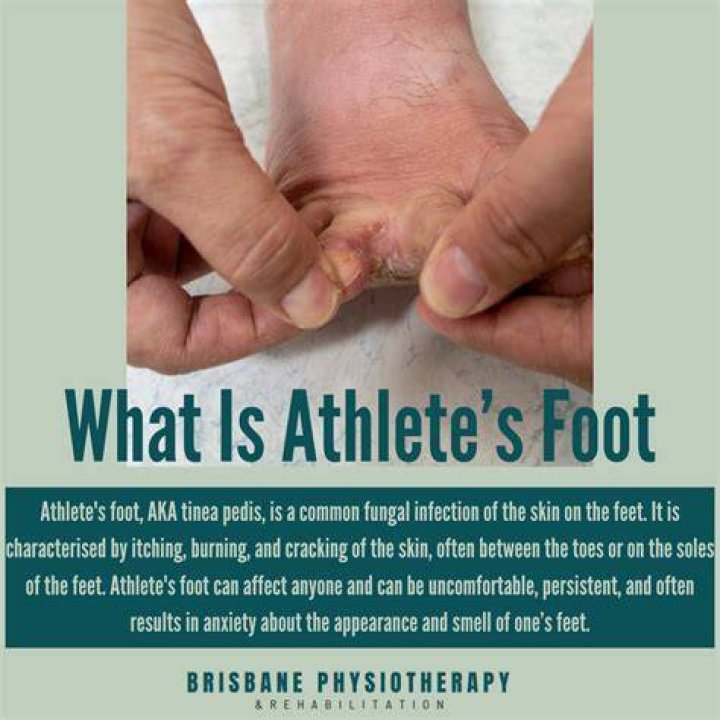 Does wearing socks make athlete's foot worse?