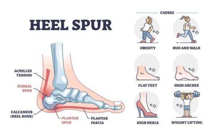 Does weight gain cause heel spurs?