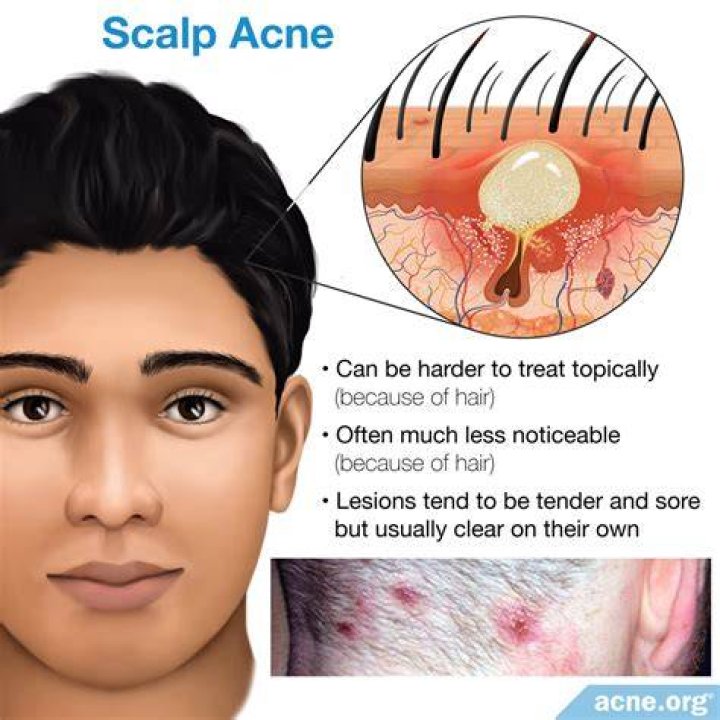 Does wet hair cause back acne?