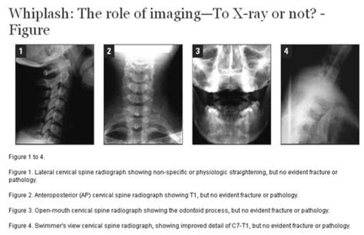 Does whiplash show up on xray?