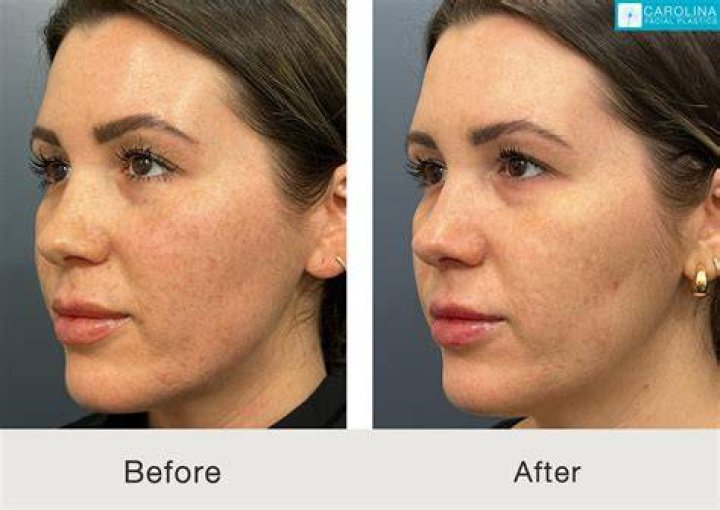 Does zinc help get rid of facial hair?