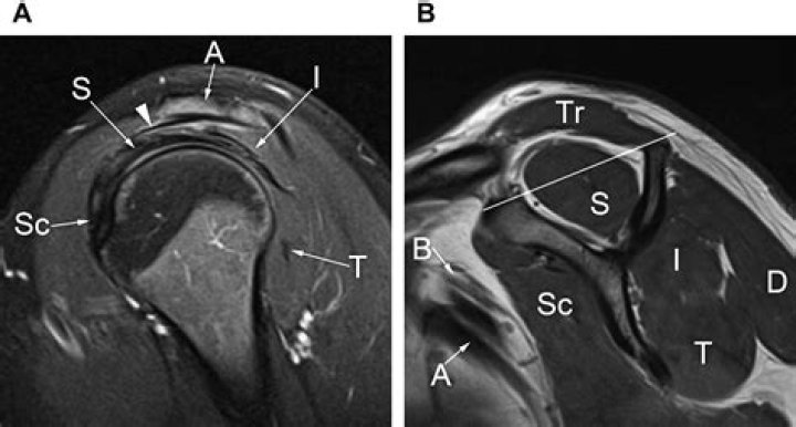 How accurate is a shoulder MRI?