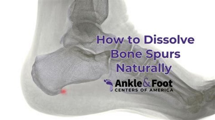 How are bone spurs removed from the foot?