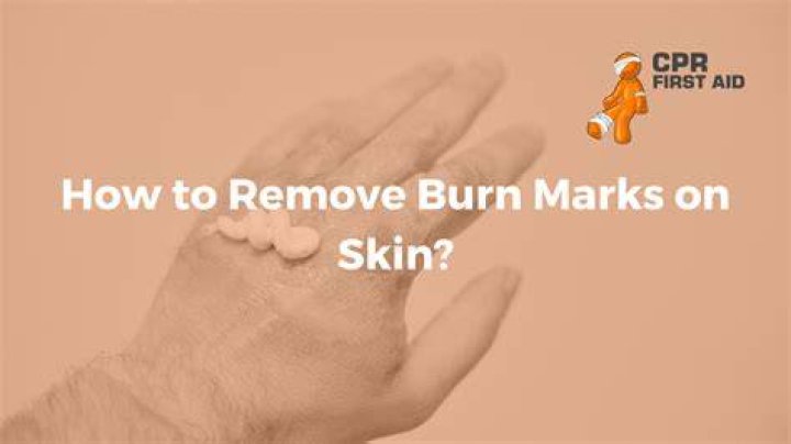 How can I get rid of burn marks on my face naturally?