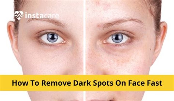 How can I lighten dark spots on my face?