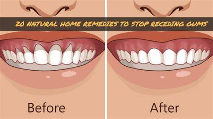 How can I prevent receding gums?