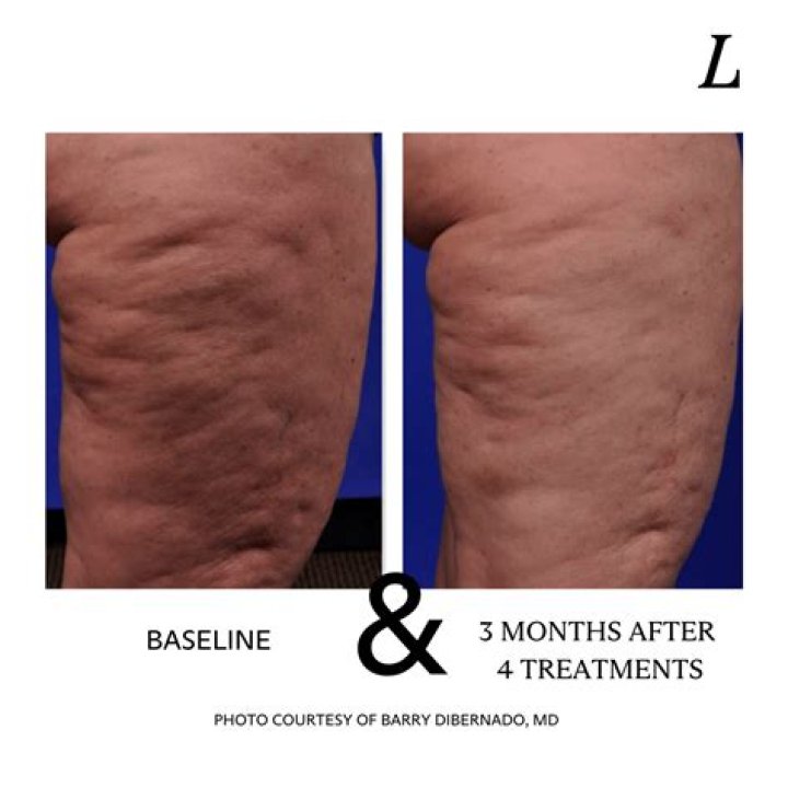 How can I reduce cellulite on my legs?