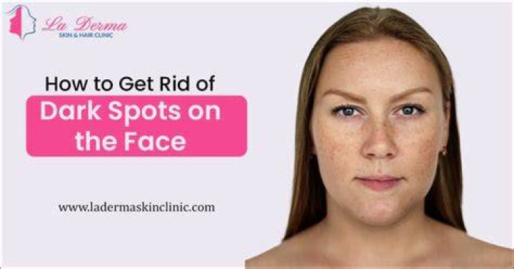 How can I remove dark spots in my face in a week?