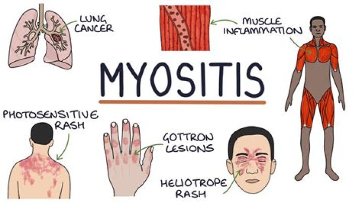 How can I treat myositis naturally?