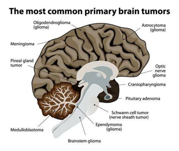 How common are brain tumors in 20s?