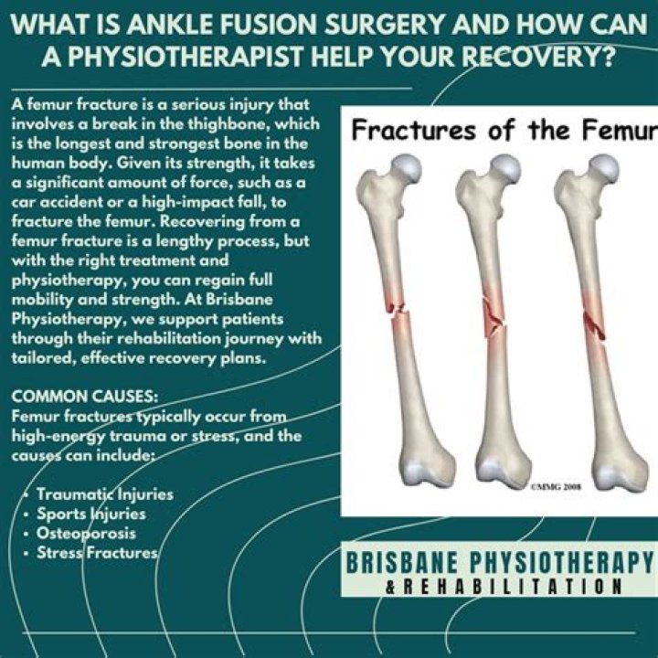 How common is it to break your femur?