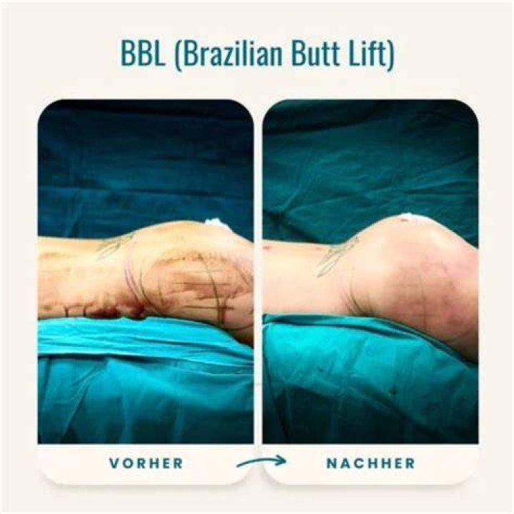How do bbls work?