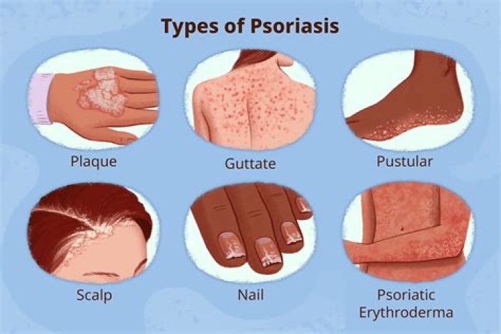 How do I know if my psoriasis is severe?