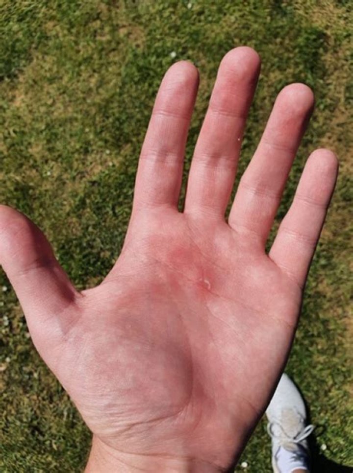 How do I prevent blisters on my hands from golf?