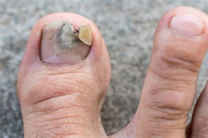 How do I stop my big toe from cracking?