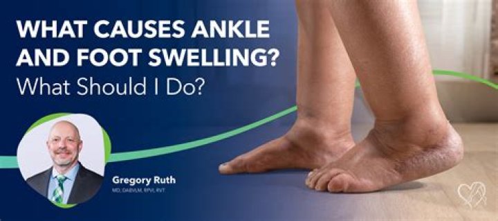 How do I stop my feet from swelling at the beach?