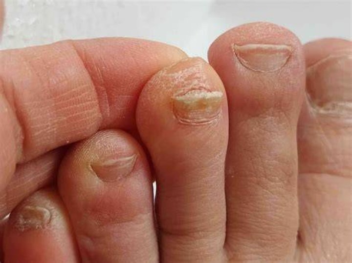 How do Podiatrists treat toenail fungus?